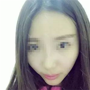 去年做了自體耳軟骨隆鼻手術(shù)，看看我的恢復(fù)過(guò)程照片，前后變化大~