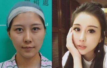 自體脂肪豐太陽穴和豐額頭前后對比圖