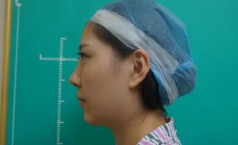 面部填充整形前后對比圖和恢復(fù)過程經(jīng)歷分享給大家