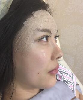 自體脂肪填充面部術(shù)后恢復(fù)圖