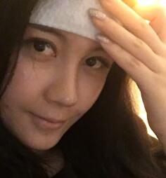 自體脂肪面部填充太陽穴和額頭第三天