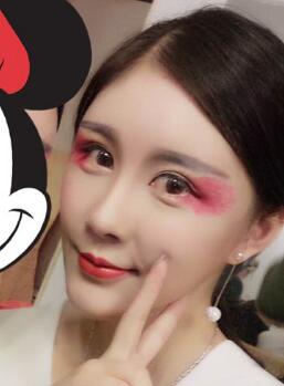 自體脂肪面部填充恢復(fù)圖