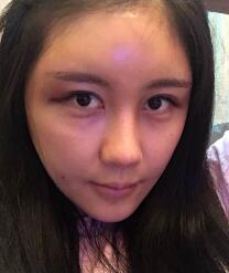 自體脂肪面部填充太陽穴和額頭