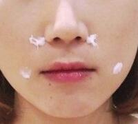 注射玻尿酸除皺價格3600元，術(shù)后果分享