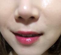 注射玻尿酸除皺價格3600元，術(shù)后果分享