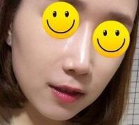 注射玻尿酸除皺價格3600元，術(shù)后果分享