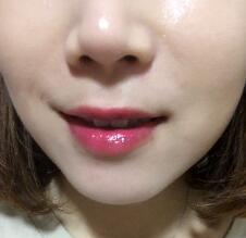 玻尿酸注射除皺