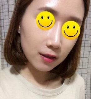 注射玻尿酸除皺價格3600元