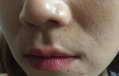 玻尿酸去法令紋