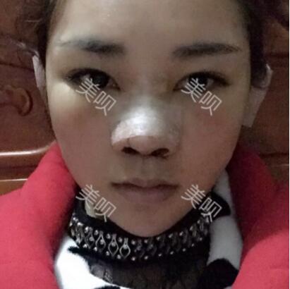 給大家分享在長沙鵬愛做的膨體隆鼻近一個月的恢復過程