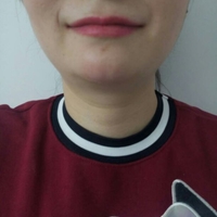 玻尿酸墊下巴后改變了我的大餅臉果漂亮妥妥的