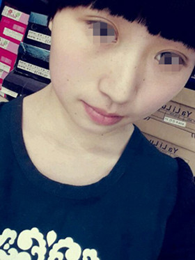 做了切開雙眼皮手術，現(xiàn)在恢復的還不錯哦