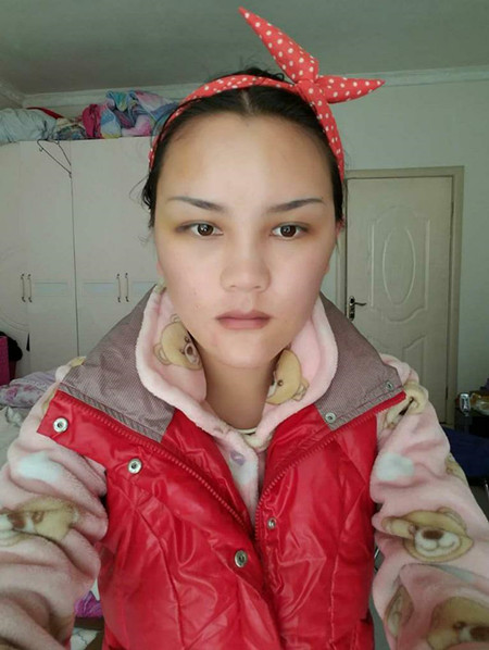 和大家分享一下我做自體脂肪面部填充的經(jīng)歷 還有果圖哦