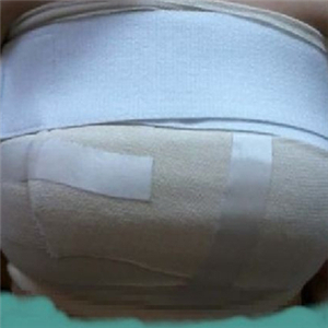 自體脂肪隆胸四個(gè)月了，曬一下恢復(fù)過(guò)程和前后對(duì)比果圖片~