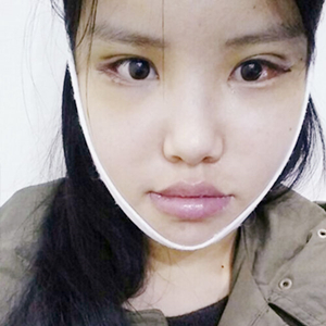 做下頜角整形手術(shù)半年了，給你們看看恢復(fù)過程照片吧~