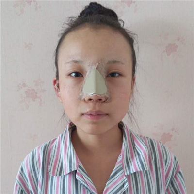 磨下頜角手術(shù)+隆鼻前后對比果圖片分享，高占巍做的哦~