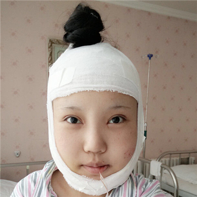 磨下頜角手術(shù)+隆鼻前后對比果圖片分享，高占巍做的哦~