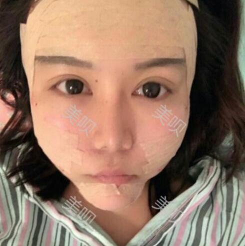 自體脂肪面部填充后年輕了好幾歲呢