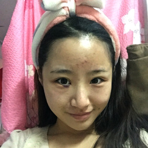 祛眼袋半年了，曬曬我的恢復(fù)前后對(duì)比果圖片哦