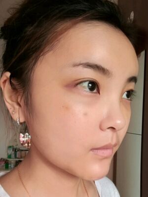 自體脂肪面部填充之后飽滿又自然，廣州曙光劉永波做噠