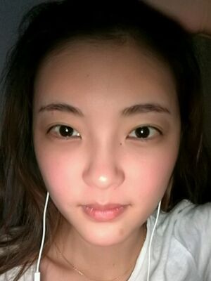 自體脂肪面部填充之后飽滿又自然，廣州曙光劉永波做噠