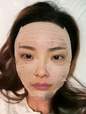 自體脂肪面部填充之后飽滿又自然，廣州曙光劉永波做噠