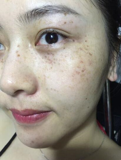 皮膚美容激光祛斑讓我基本告別小雀斑