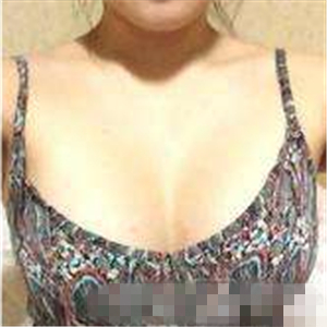 老媽隆胸失敗假體取出，還是自然點好~