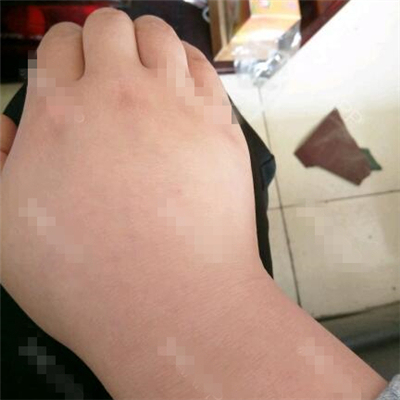 做了副乳吸脂手術(shù)半年了，分享前后對(duì)比果圖片~