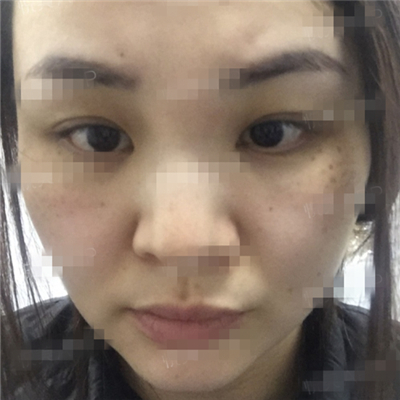 面部奧美定取出手術(shù)前后對比果圖片分享，銅雀臺做的呢~