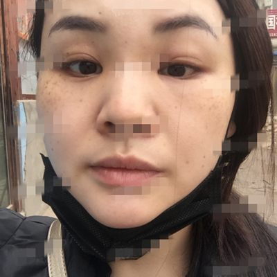 面部奧美定取出手術(shù)前后對比果圖片分享，銅雀臺做的呢~