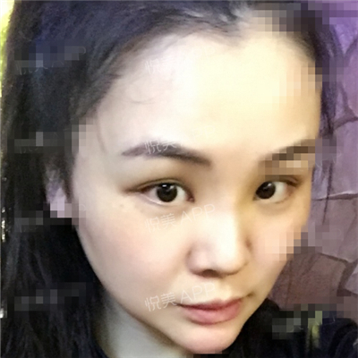 面部奧美定取出手術(shù)前后對比果圖片分享，銅雀臺做的呢~