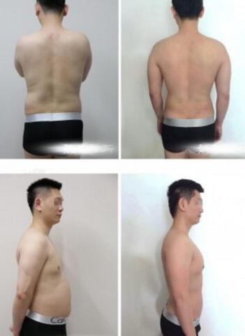 吸脂減肥前后對(duì)比圖
