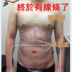 吸脂減肥手術(shù)瘦身，也算一個(gè)正能量胖子逆襲的故事吧