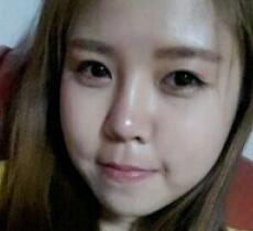 玻尿酸除皺抗衰老去法令紋真實(shí)案例分享