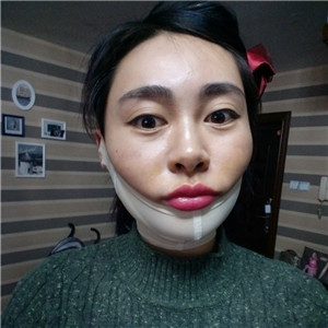 光纖溶脂去雙下巴臉型更好看了