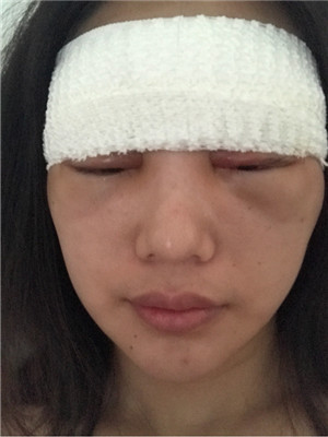 自體脂肪隆眉弓后，更有精神了