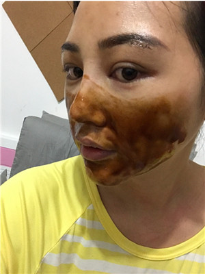 自體脂肪隆眉弓后，更有精神了