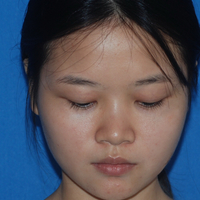 玻尿酸隆鼻改變了大鼻翼給大家分享下我的恢復(fù)過程