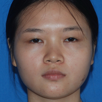玻尿酸隆鼻改變了大鼻翼給大家分享下我的恢復(fù)過程