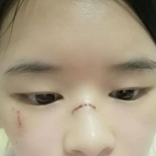 分享手術(shù)切除祛疤恢復(fù)過程希望對(duì)大家有幫助