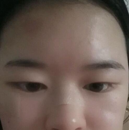 分享手術(shù)切除祛疤恢復(fù)過程希望對(duì)大家有幫助