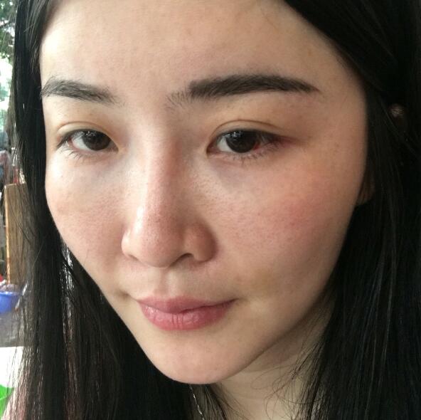 分享我的去胎記過程遺傳性雀斑終于被甩掉了