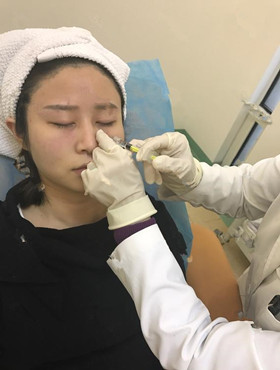 記錄了玻尿酸填充淚溝手術前后過程，還有前后對比圖哦