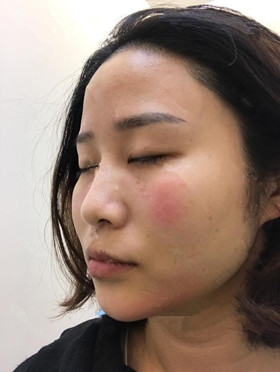 記錄了玻尿酸填充淚溝手術前后過程，還有前后對比圖哦