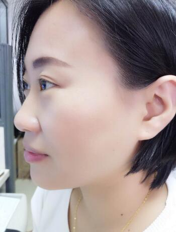 武漢中愛注射瘦臉去魚尾紋一個月