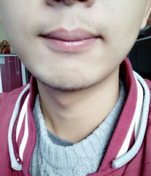 胡須種植后長(zhǎng)出來(lái)的胡子較為滿(mǎn)意