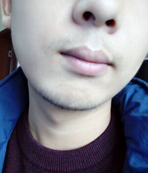 胡須種植后長(zhǎng)出來(lái)的胡子較為滿(mǎn)意