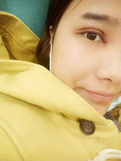 全切雙眼皮讓我告別腫泡眼變女神