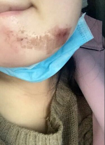 激光祛疤痕整形手術(shù)真的改變了我的人生